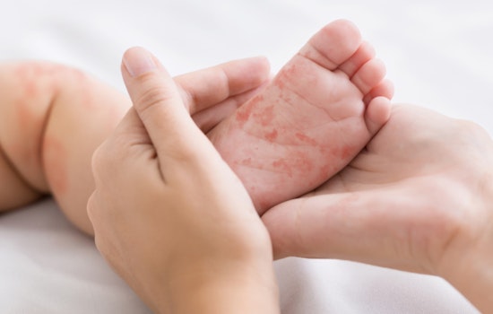 Health Alert Issued in Coconino County After Resident Diagnosed with Measles, Public Urged to Monitor Symptoms