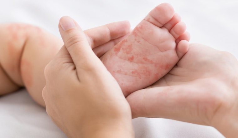 Health Alert Issued in Coconino County After Resident Diagnosed with Measles, Public Urged to Monitor Symptoms