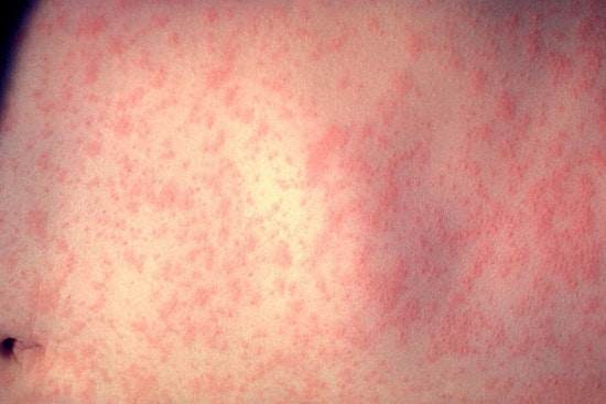 Health Alert: Measles Exposure Warning for Visitors of DMC Huron Valley-Sinai Hospital in Oakland County