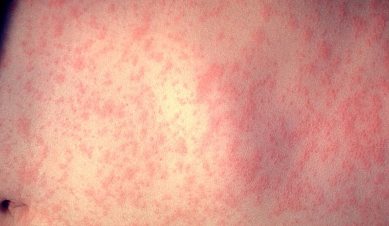 Health Alert: Measles Exposure Warning for Visitors of DMC Huron Valley-Sinai Hospital in Oakland County