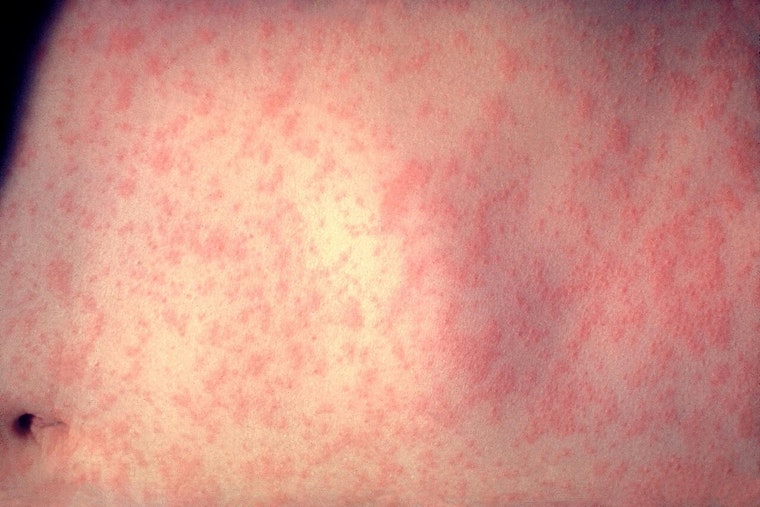 Measles Alert in Boston and Westborough After Visitor Diagnosed, DPH and CDC Track Potential Exposures