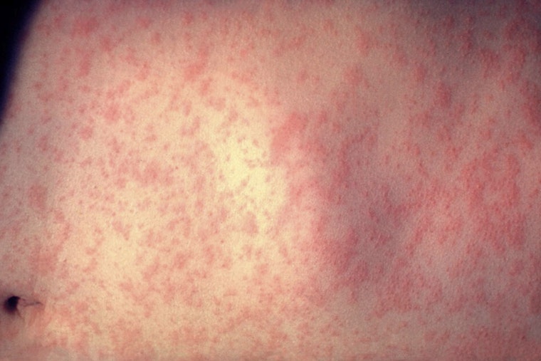 Measles Exposure Alert for Passengers at Raleigh-Durham International Airport on December 10