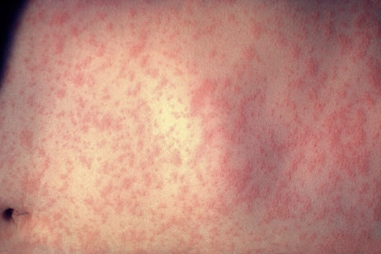 Measles Exposure Alert for Passengers at Raleigh-Durham International Airport on December 10
