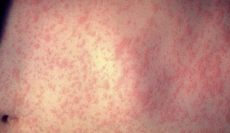 Measles Exposure Alert for Passengers at Raleigh-Durham International Airport on December 10