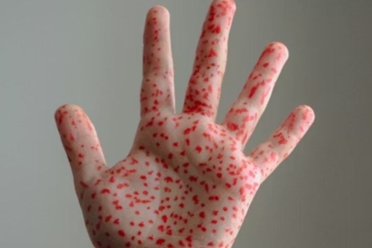 Measles Scare Shadows Holiday Shoppers In Walnut Creek