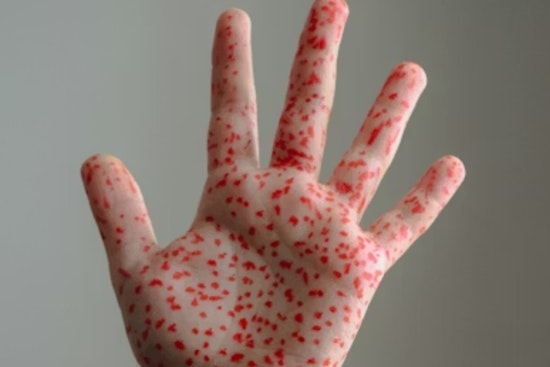 Measles Scare Shadows Holiday Shoppers In Walnut Creek