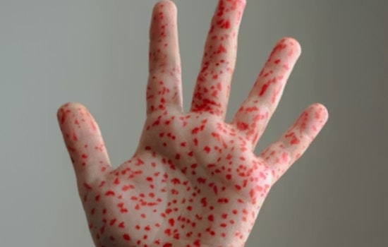 Measles Scare Shadows Holiday Shoppers In Walnut Creek