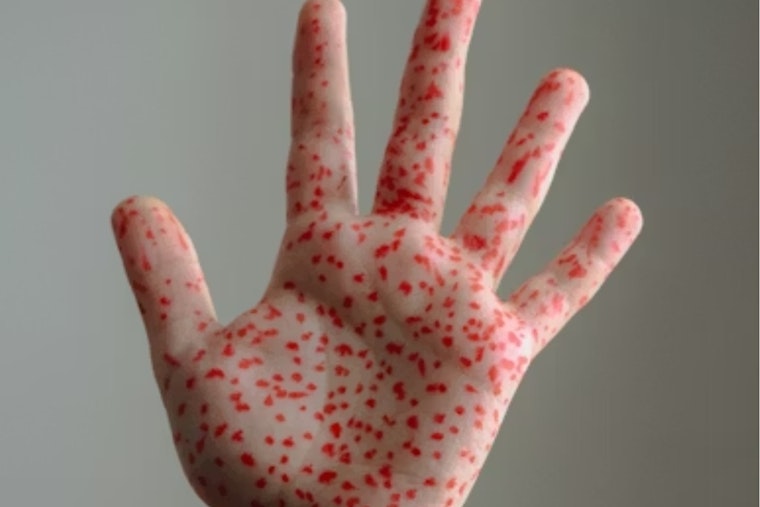 Unvaccinated Individual Causes Measles Scare at Bingham Kopper Kids in South Jordan