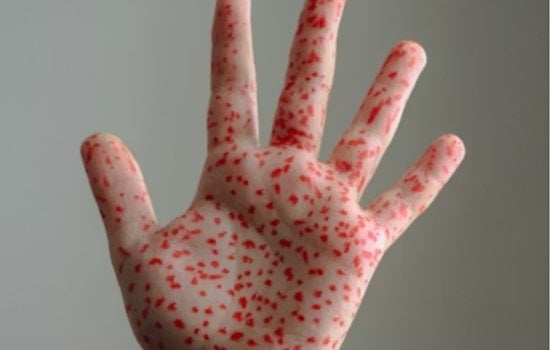 Unvaccinated Individual Causes Measles Scare at Bingham Kopper Kids in South Jordan