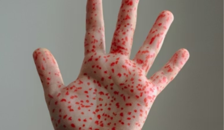 Unvaccinated Individual Causes Measles Scare at Bingham Kopper Kids in South Jordan