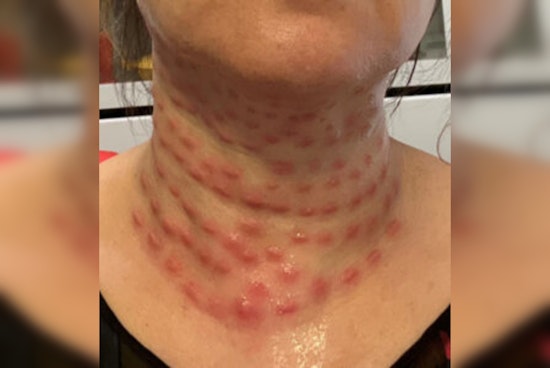 Flushing Cosmetologist Charged with Assault for Illegal Beauty Treatments, Could Face 7 Years in Prison