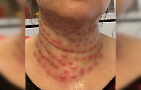 Flushing Cosmetologist Charged with Assault for Illegal Beauty Treatments, Could Face 7 Years in Prison