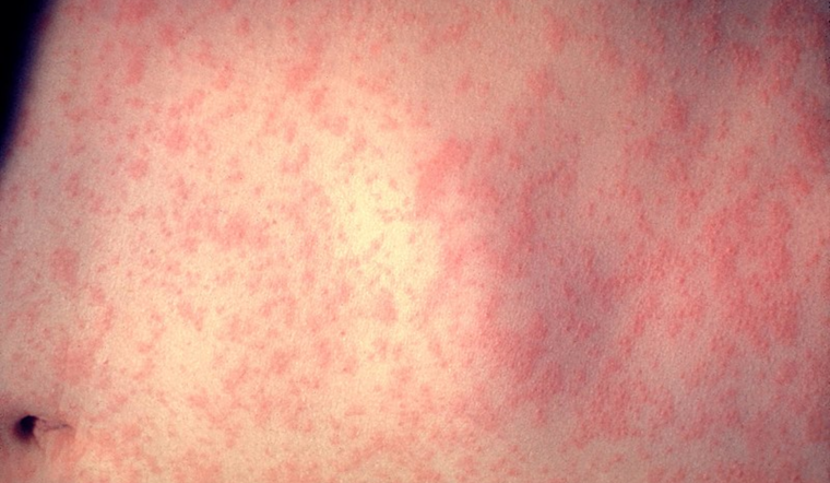 Outbreak of Measles Strikes South Plains, Texas; 58 Cases Reported with Hospitalizations Amid Vaccination Urgency