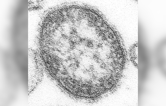 Measles Case Confirmed in Howard County, Maryland, Health Officials Issue Exposure Warning
