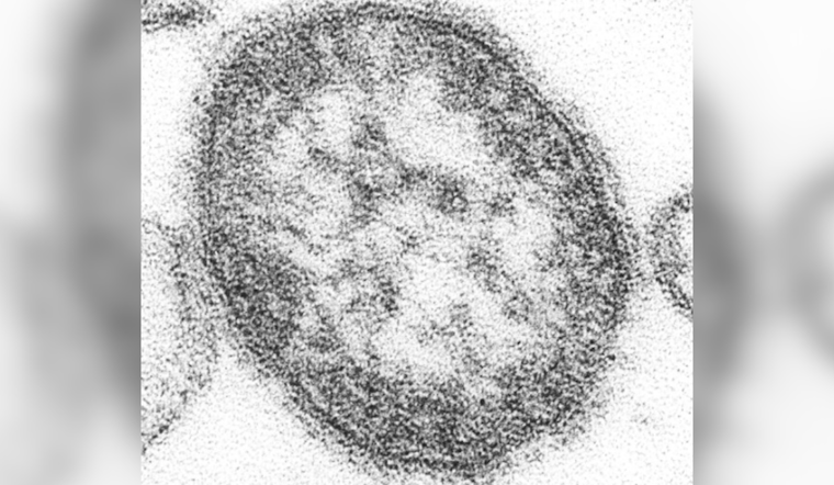 Measles Case Confirmed in Howard County, Maryland, Health Officials Issue Exposure Warning