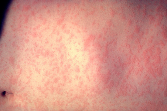 Measles Cases on the Rise in Maryland, Prince George's County Reports New Infections Linked to International Travel