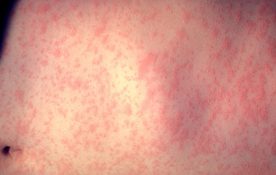 Measles Cases on the Rise in Maryland, Prince George's County Reports New Infections Linked to International Travel