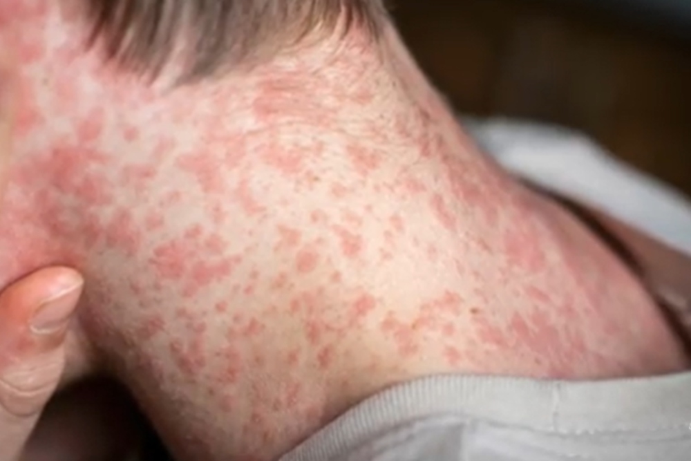 Measles Menace: Over 400 Cases Surge in Texas and New Mexico as US Outbreak Alarms Health Officials