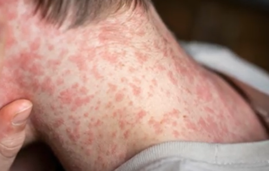 Measles Menace: Over 400 Cases Surge in Texas and New Mexico as US Outbreak Alarms Health Officials