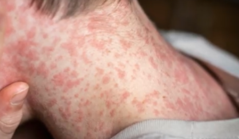 Measles Menace: Over 400 Cases Surge in Texas and New Mexico as US Outbreak Alarms Health Officials