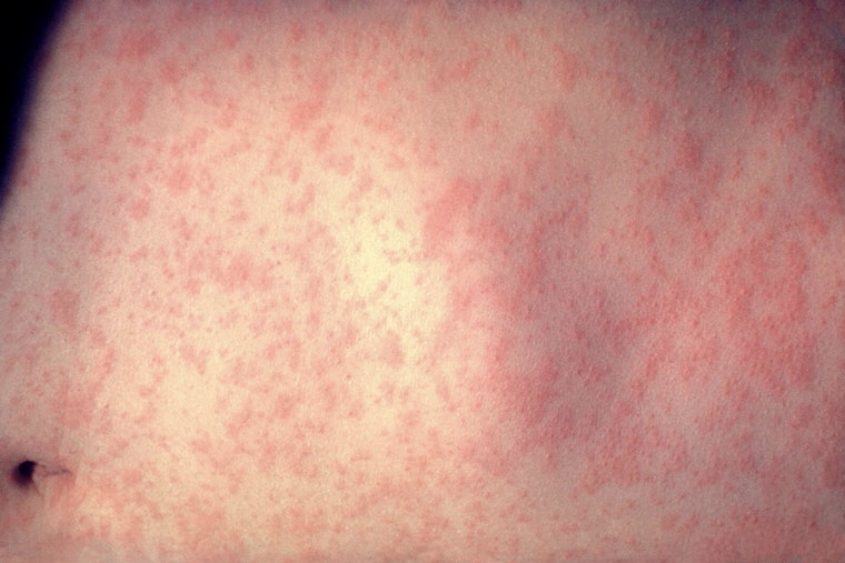 Measles Outbreak Escalates in Texas and New Mexico with 279 Cases Reported, Health Officials Urge Vaccination