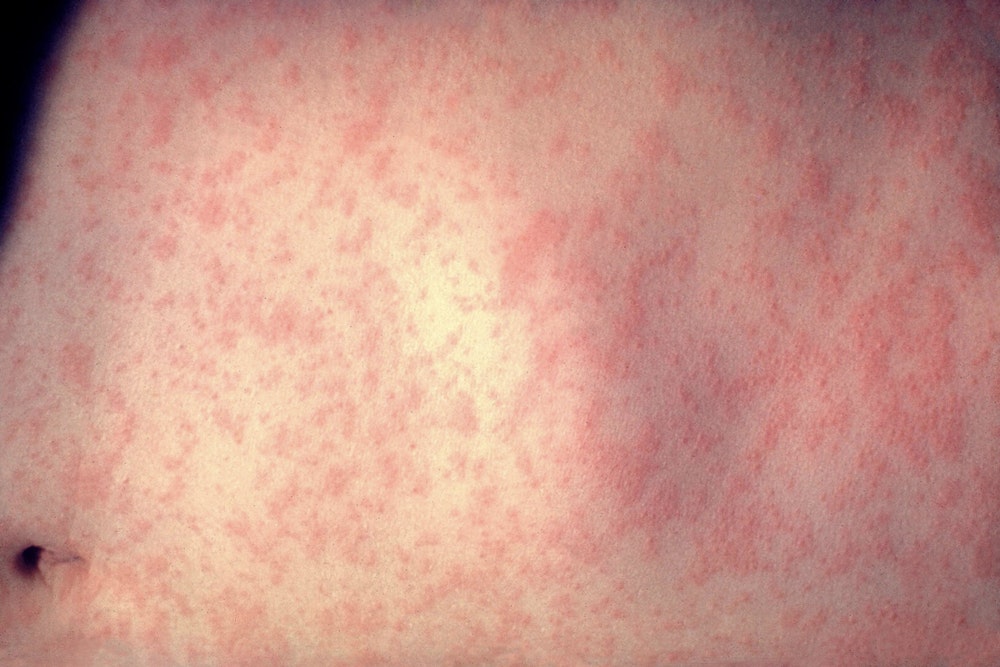 Measles Outbreak Escalates in Texas and New Mexico with 279 Cases Reported, Health Officials Urge Vaccination