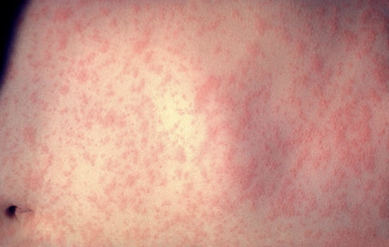 Measles Outbreak Escalates in Texas and New Mexico with 279 Cases Reported, Health Officials Urge Vaccination