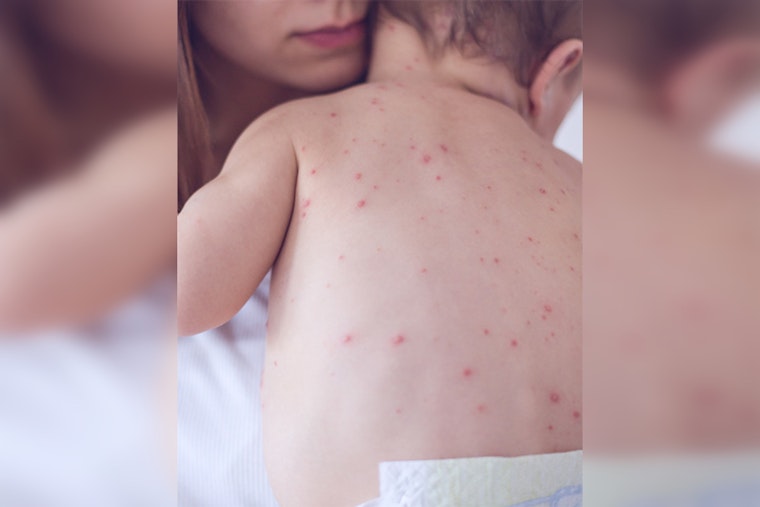 Nashville Health Officials Urge Vaccinations as U.S. Measles Cases Rise, No Local Cases Reported