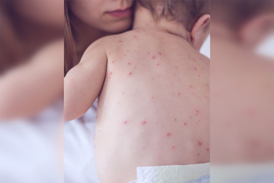 Nashville Health Officials Urge Vaccinations as U.S. Measles Cases Rise, No Local Cases Reported