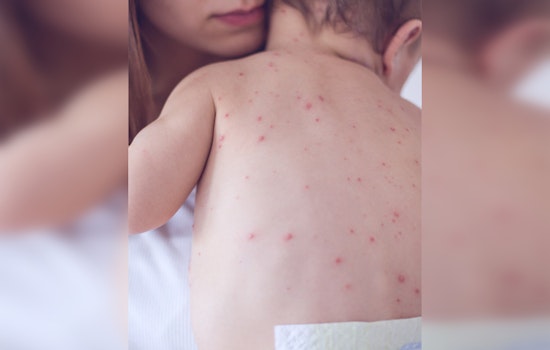 Nashville Health Officials Urge Vaccinations as U.S. Measles Cases Rise, No Local Cases Reported