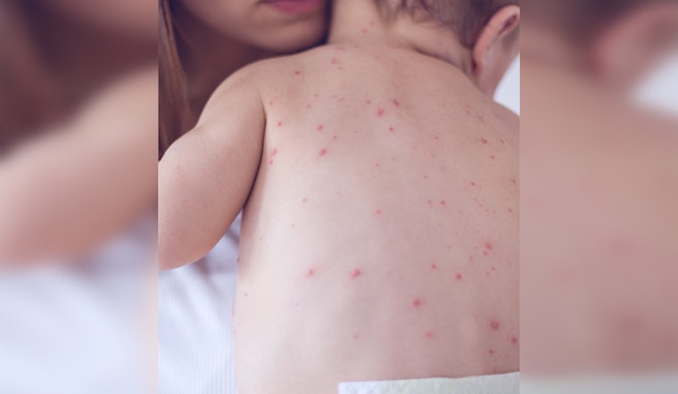 Nashville Health Officials Urge Vaccinations as U.S. Measles Cases Rise, No Local Cases Reported