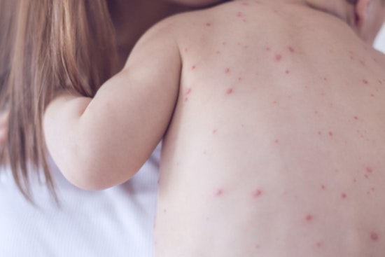 Philadelphia Health Department Issues Measles Exposure Alert, Urges Residents to Check Immunity Status