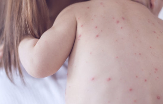 Philadelphia Health Department Issues Measles Exposure Alert, Urges Residents to Check Immunity Status