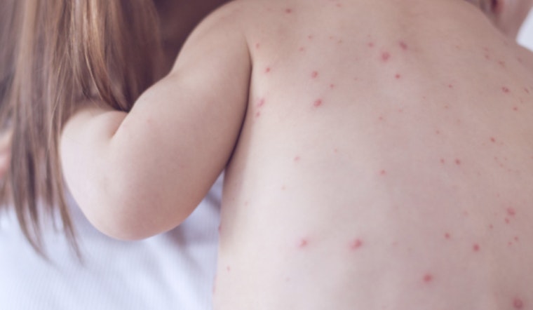 Philadelphia Health Department Issues Measles Exposure Alert, Urges Residents to Check Immunity Status