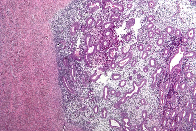 Cincinnati Scientist Unveils Game-Changing At-Home Endometriosis Test: A Future Free from Surgical Diagnosis