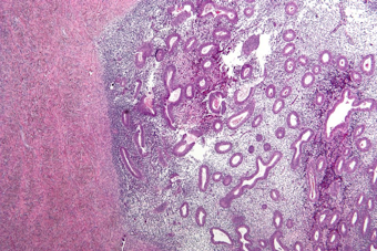 Cincinnati Scientist Unveils Game-Changing At-Home Endometriosis Test: A Future Free from Surgical Diagnosis
