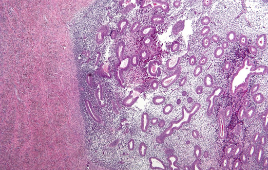 Cincinnati Scientist Unveils Game-Changing At-Home Endometriosis Test: A Future Free from Surgical Diagnosis