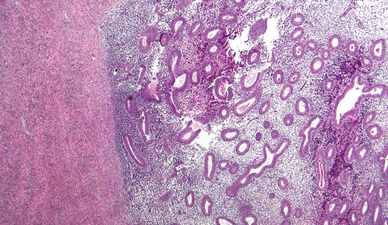 Cincinnati Scientist Unveils Game-Changing At-Home Endometriosis Test: A Future Free from Surgical Diagnosis