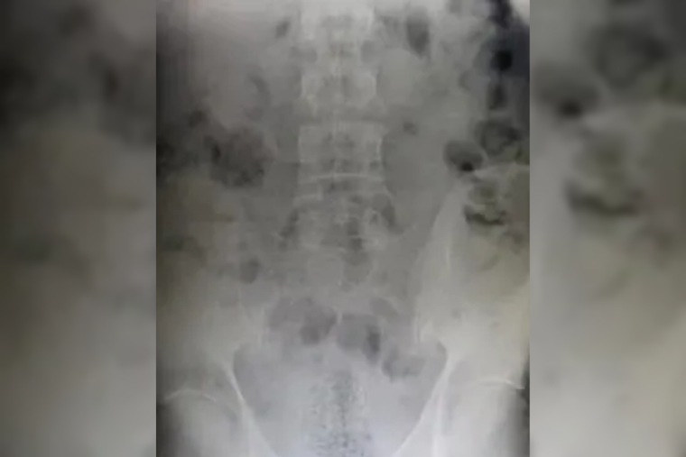 El Paso CBP Officers Thwart Drug Smuggling Attempt, Man Concealed Fentanyl Inside Body at Ysleta Crossing