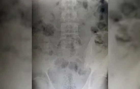El Paso CBP Officers Thwart Drug Smuggling Attempt, Man Concealed Fentanyl Inside Body at Ysleta Crossing