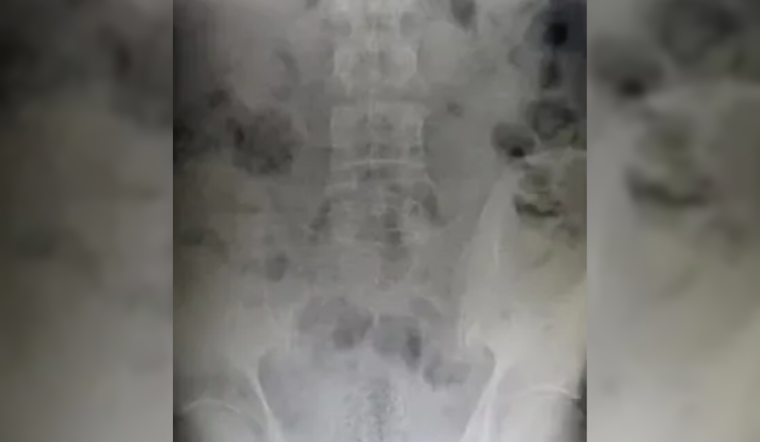 El Paso CBP Officers Thwart Drug Smuggling Attempt, Man Concealed Fentanyl Inside Body at Ysleta Crossing