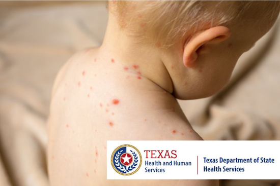 Measles Outbreak Strikes Texas South Plains and Panhandle, Health Officials Advocate for MMR Vaccination