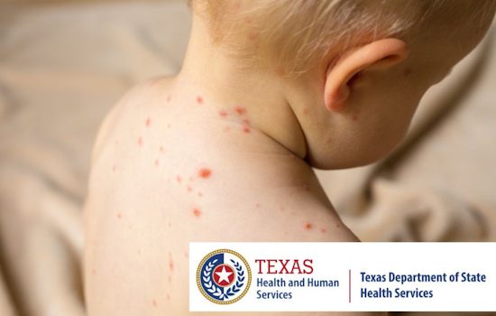 Measles Outbreak Strikes Texas South Plains and Panhandle, Health Officials Advocate for MMR Vaccination