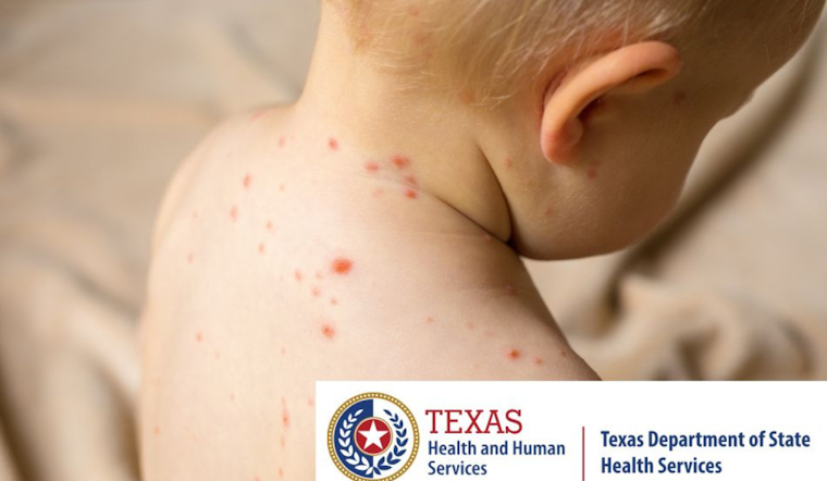 Measles Outbreak Strikes Texas South Plains and Panhandle, Health Officials Advocate for MMR Vaccination