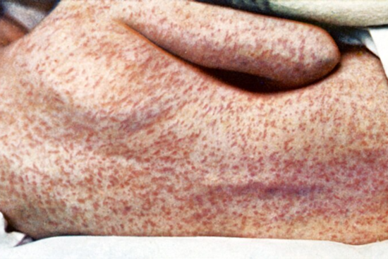 Michigan Battles First Measles Outbreak in Montcalm County Since 2019, Health Officials Urge Vaccinations
