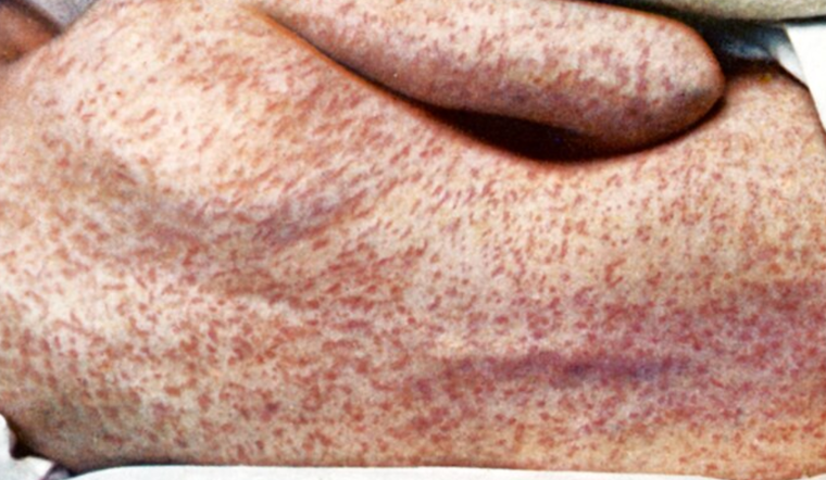 Michigan Battles First Measles Outbreak in Montcalm County Since 2019, Health Officials Urge Vaccinations
