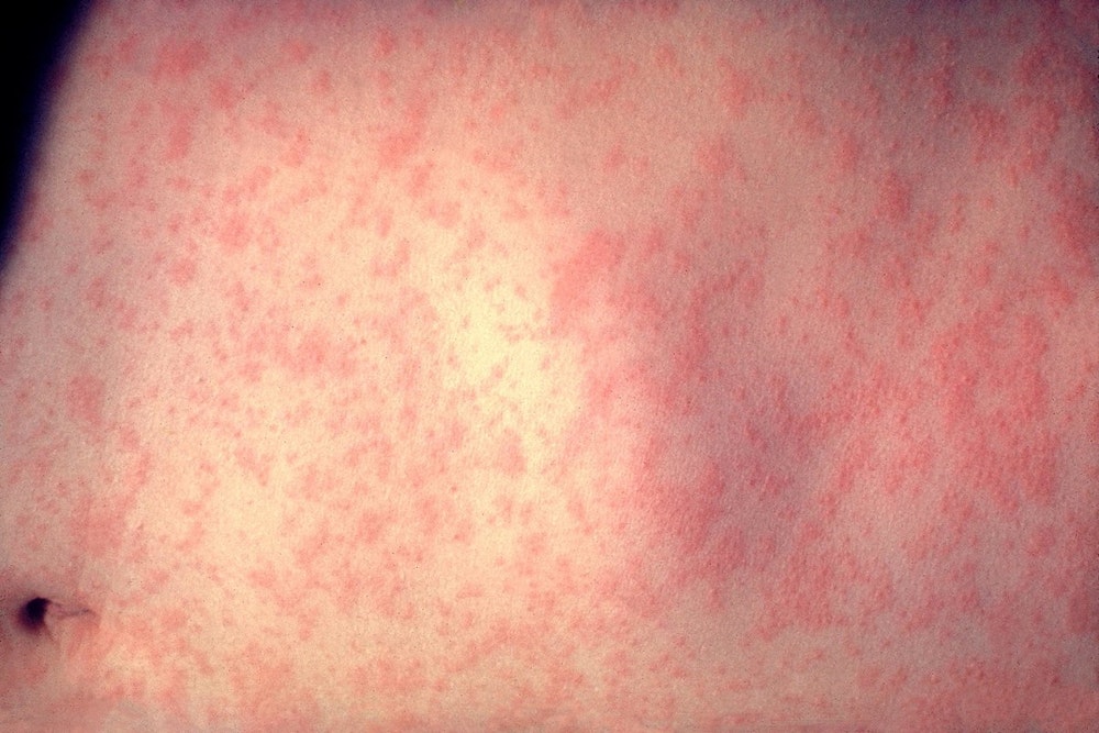 Second Measles Case Strikes a Vaccinated Adult Amid Texas Outbreak