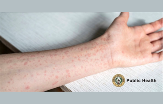 Texas Health Officials Warn of Measles Outbreak in South Plains and Panhandle, Urge Vaccination
