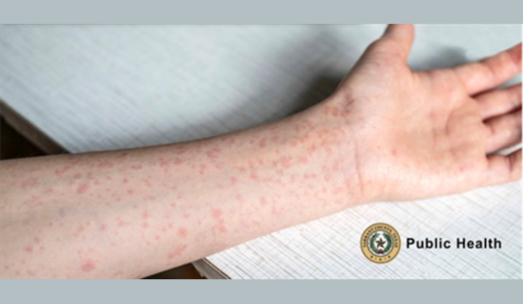 Texas Health Officials Warn of Measles Outbreak in South Plains and Panhandle, Urge Vaccination