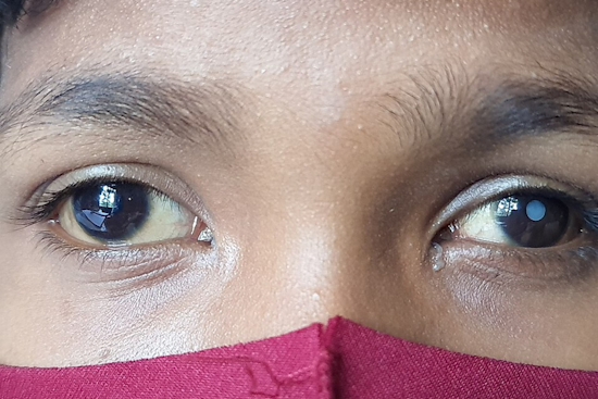 University of Cincinnati Study Reveals Fear as Barrier to Cataract Surgery Among Patients